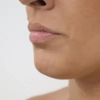 labios-antes-1