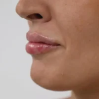 labios-despues-1